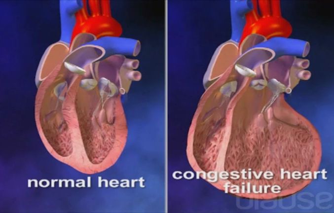 Insuffisance cardiaque et congestive