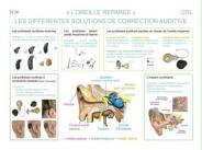 orl_otologie_corrections_auditives