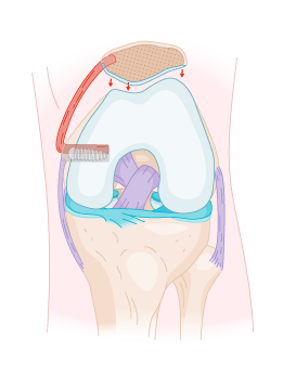 instabilité rotulienne - reconstruction ligamentaire