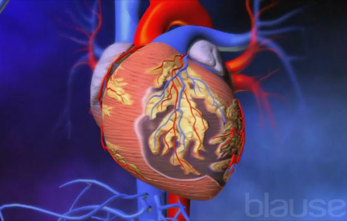 Infarctus du myocarde