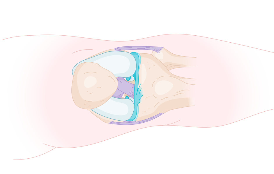 La chirurgie reconstructrice du genou