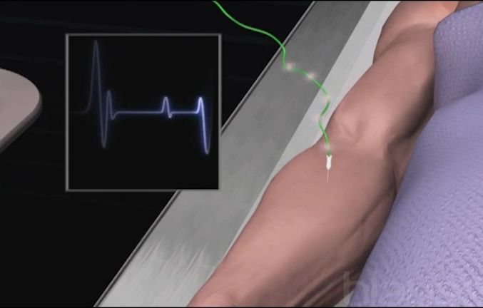 Electromyogramme - Electrodiagnostic