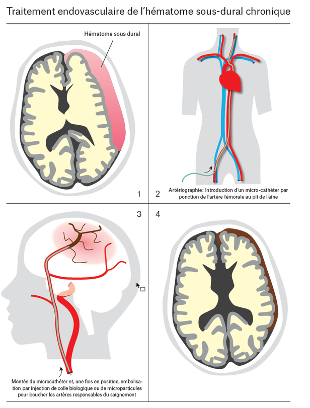 Traitement endovasculaire de l’hématome sous-dural chronique - Service ...