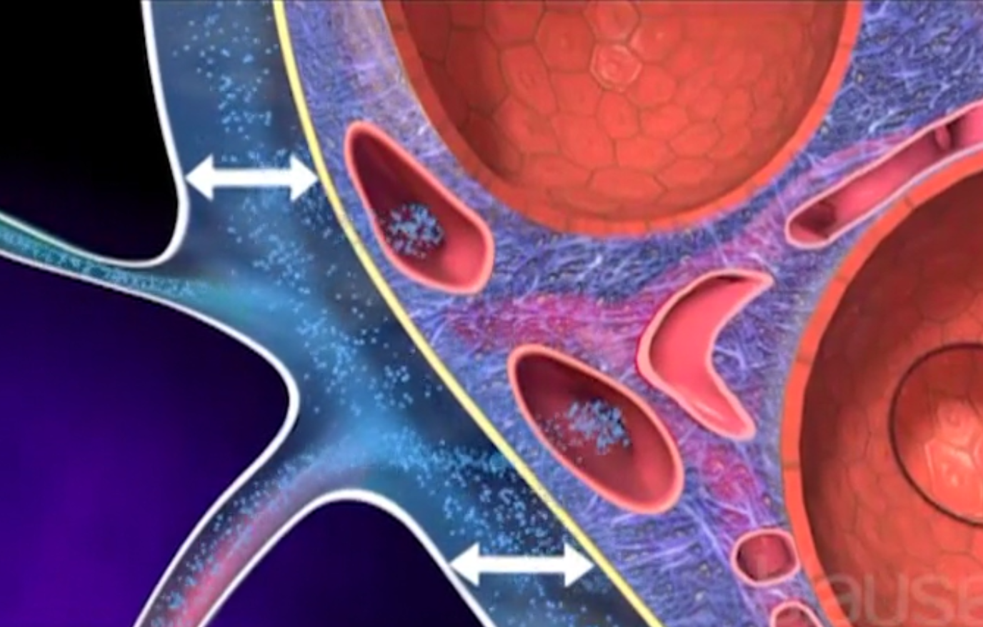 Épanchement pleural