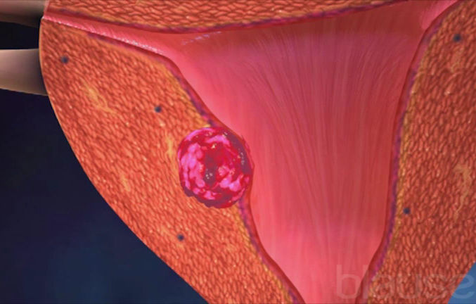 Cancer de l'utérus