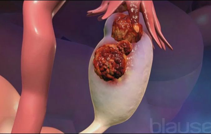 Cancer de l'ovaire