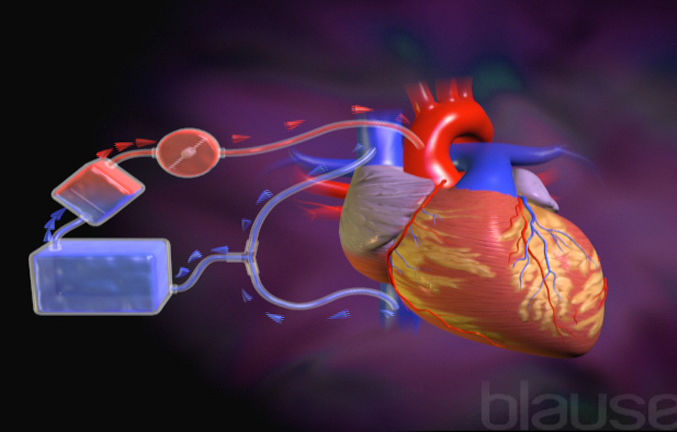 Cœur-poumon artificiel