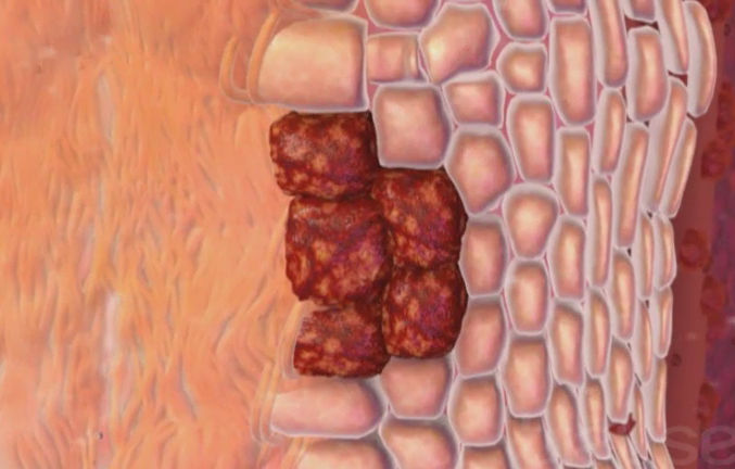 Cancer de l'oesophage