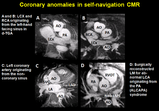Coronary anomalies in self-navigation CMR
