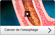 Cancer de l'oesophage