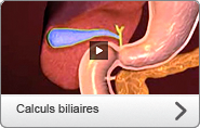 Vidéo calculs biliaires