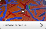 Cirrhose hépatique