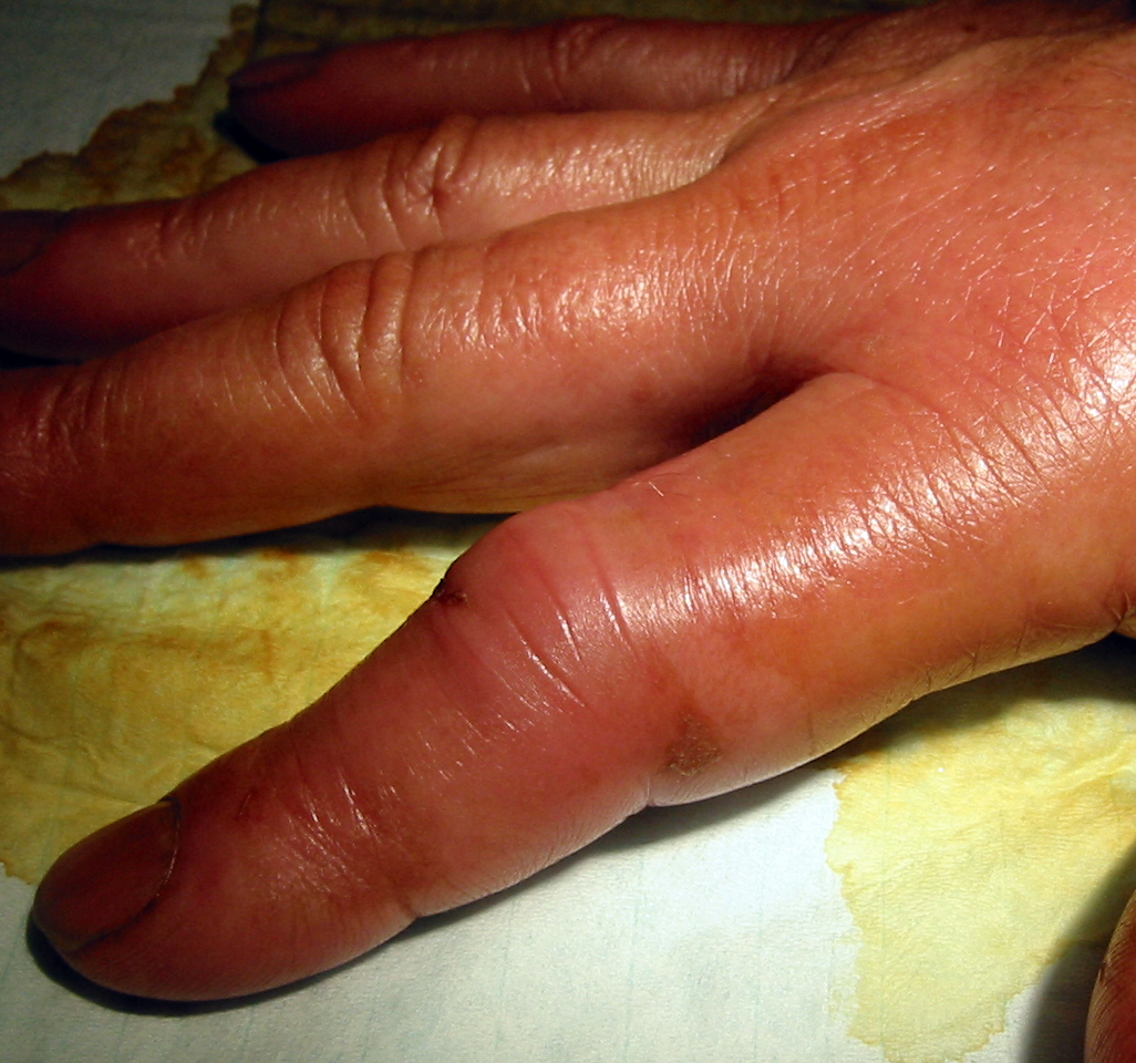 arthrite septique
