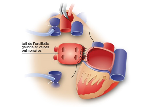 Mise en place du coeur sain chez le patient receveur