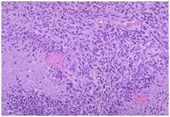 Glioblastoma multiforme