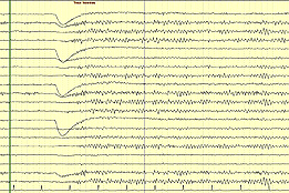 Un tracé normal EEG chez un jeune adulte