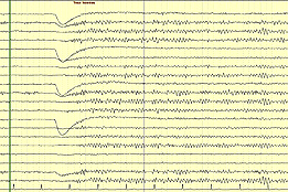 Un tracé normal EEG chez un jeune adulte