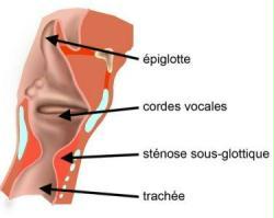 stenoses larynx