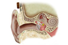 les implants de l'oreille moyenne