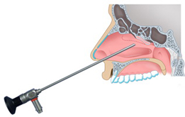 Schéma d'une endoscopie des sinus