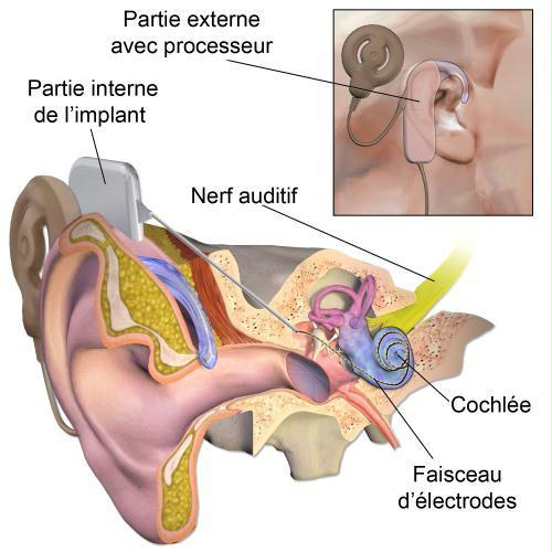 orl_implant_cochleaire.jpg