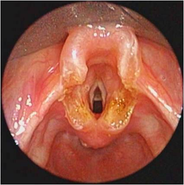 Image d'une chirurgie par laser CO2