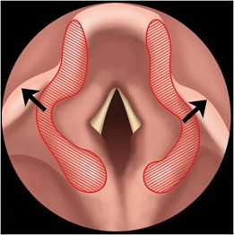 Illustration d'une chirurgie par laser CO2