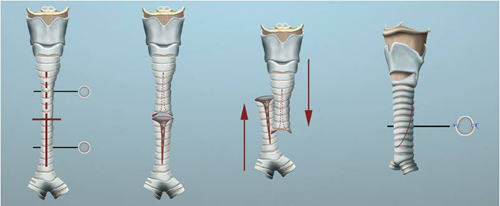 Schéma expliquant la trachéoplastie de glissement
