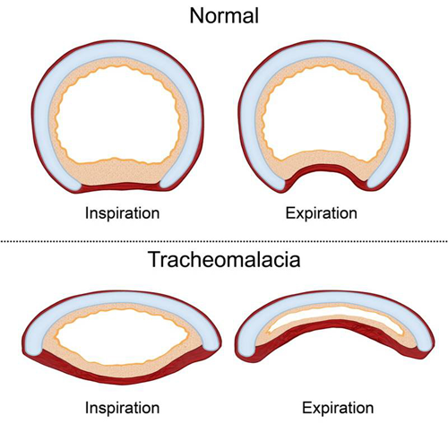 Schéma d'une trachéomalacie