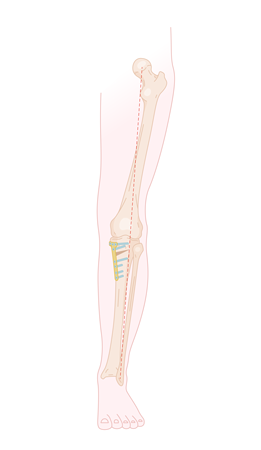 otr-genou-lesion-cartilage_arthrose-large