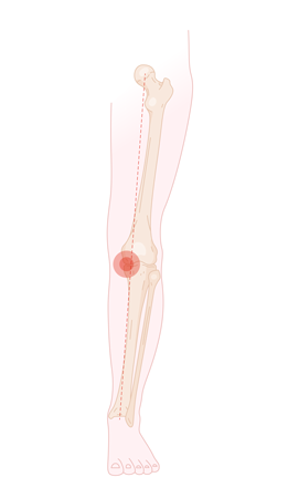 otr-genou-lesion-cartilage_arthrose-large