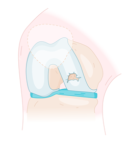 otr-genou-lesion-cartilage_arthrose