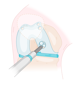 otr-genou-lesion-cartilage_mosaicplastie