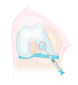 otr-genou-lesion-cartilage_patch