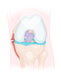 Déchirure du ligament collatéral interne - Service d'orthopédie et ...