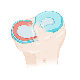 otr-genou-menisques_transplantation-apres