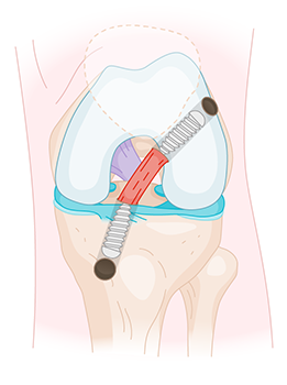 Ligament croisé antérieur réparé