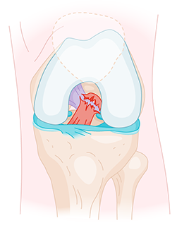 Rupture du ligament croisé antérieur